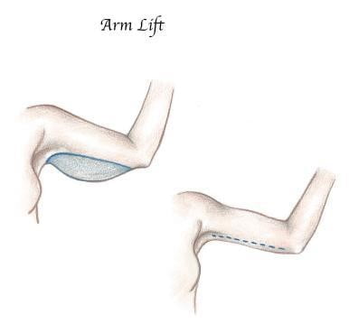 arm lift - Arm Reduction Surgery