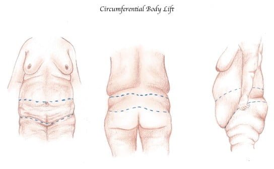 Circumferential Body Lift Procedure Plano TX - Belt Lipectomy