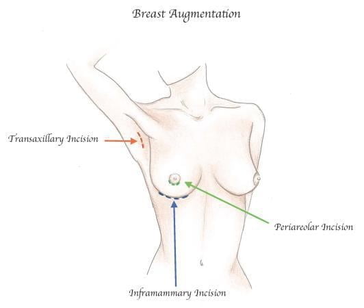 Butt Lift - Breast Augmentation