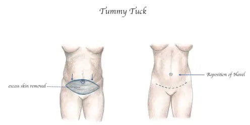 Abdominoplastia