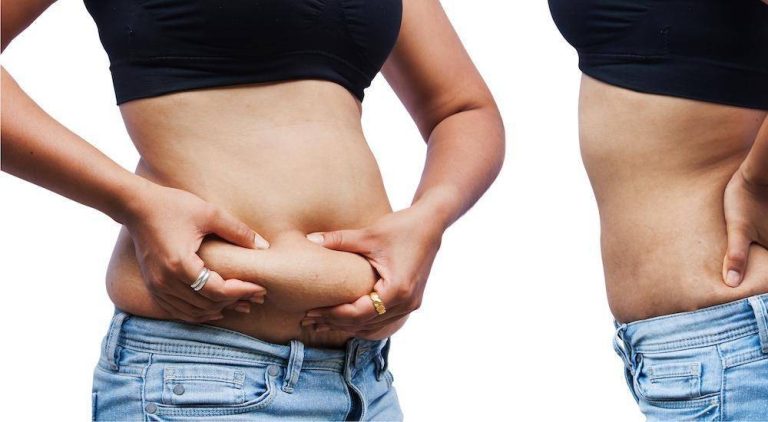 After Weight Loss How Do You Get Rid Of Excess Skin