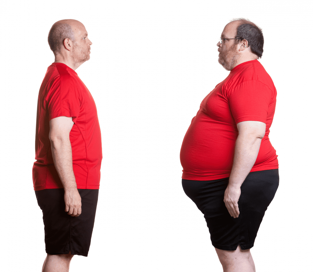 Surgical Weight Loss-before and after