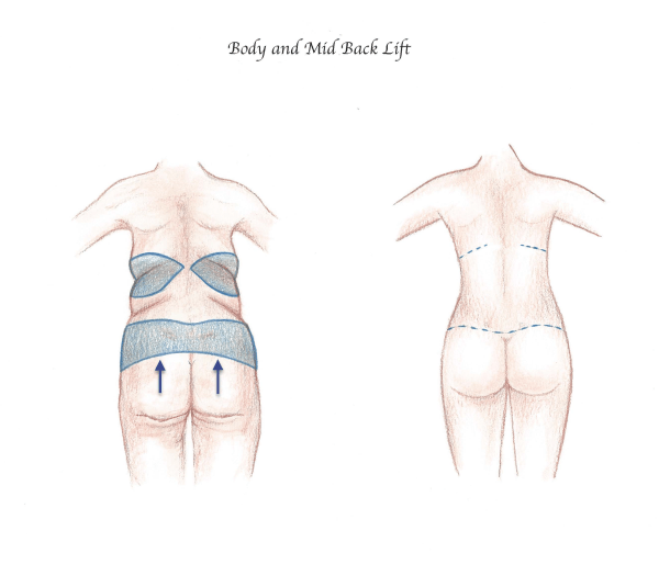 Los Angeles Butt Lift & Augmentation