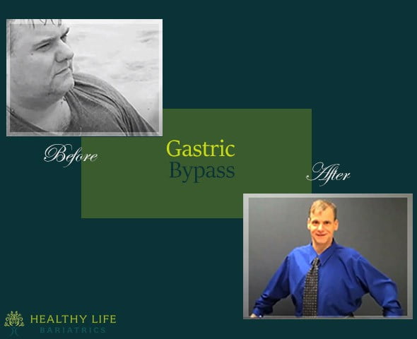 Before and after Gastric Bypass Surgery Los Angeles