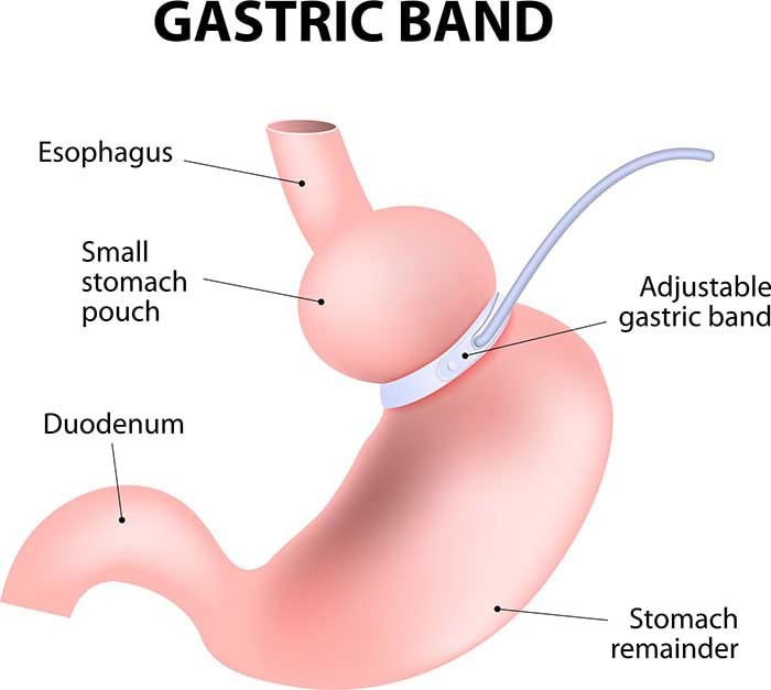 Gastric Band-Lap Band Los Angeles