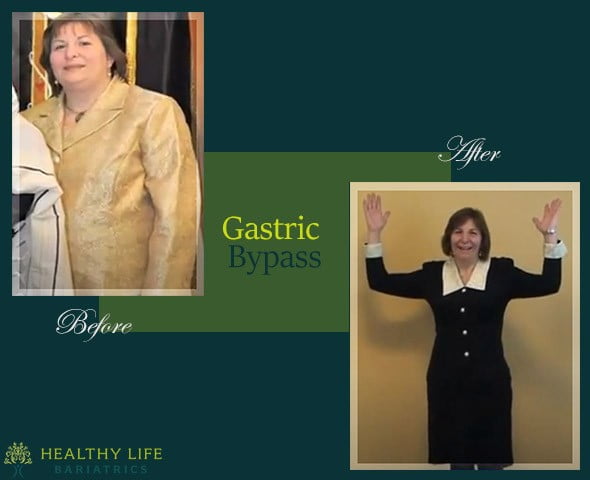 Gastric Bypass Surgrey Before and After in Los Angeles