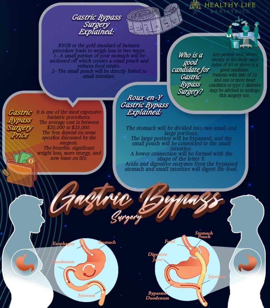 Gastric Bypass Surgery's infographic in Los Angeles