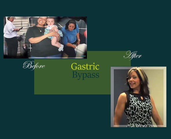 A woman is shown before and after a gastric bypass surgery.