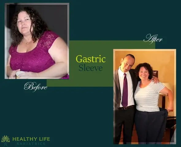 Gastric sleeve before and after Los Angeles, CA.