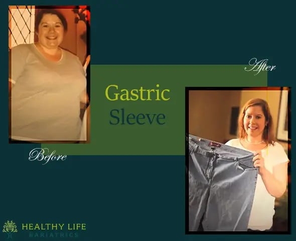 Gastric sleeve before and after Los Angeles..