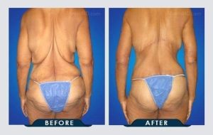 Tummy tuck before and after.