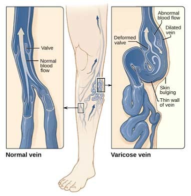 Varicose veins- Los Angeles CA