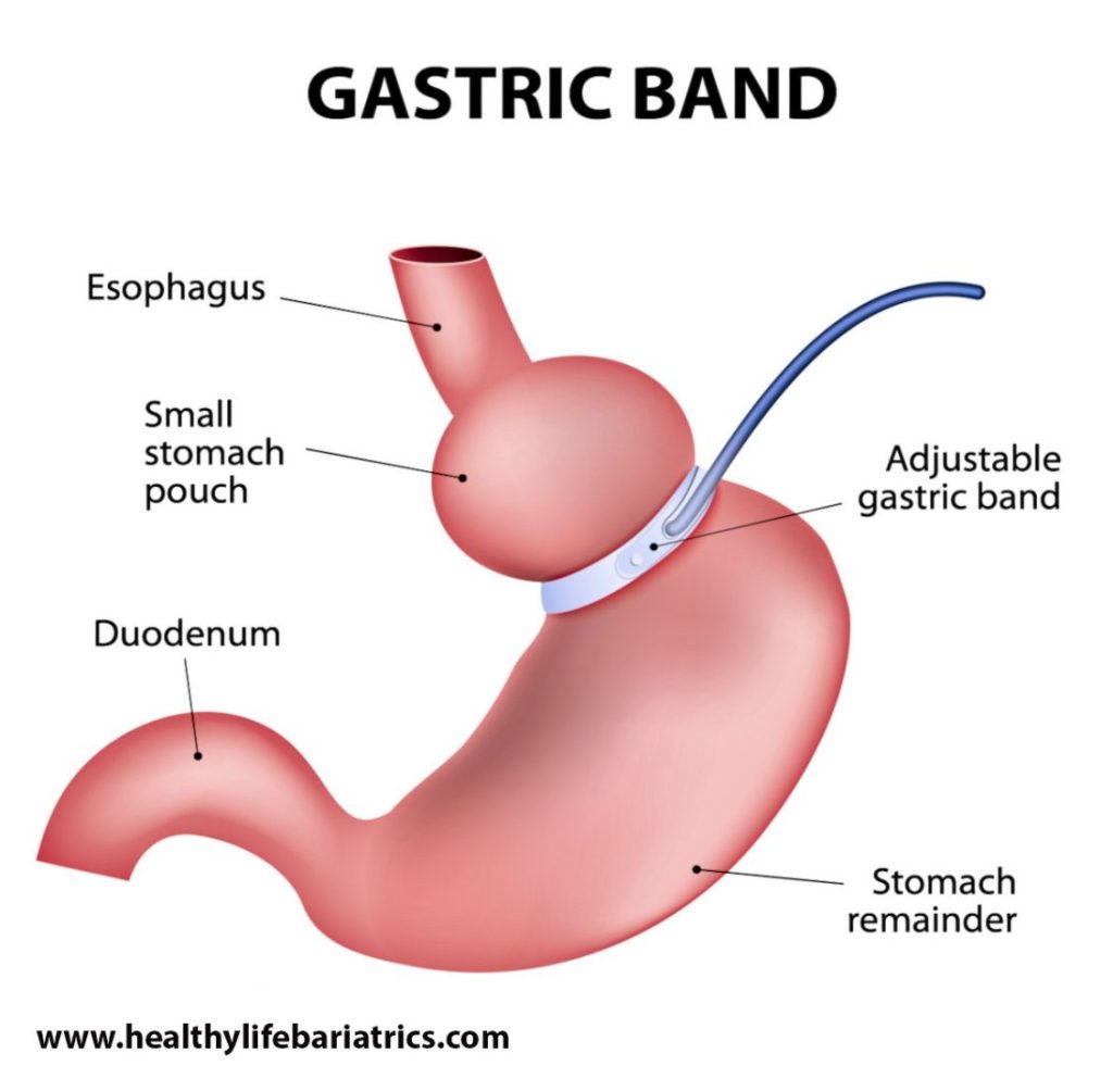 A diagram showing the anatomy of a gastric band.