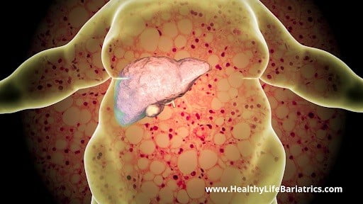 A person's liver is shown in a 3d image.