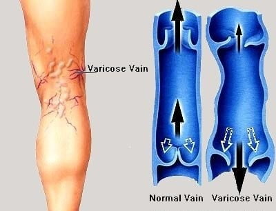 A diagram of varicose veins and normal veins.