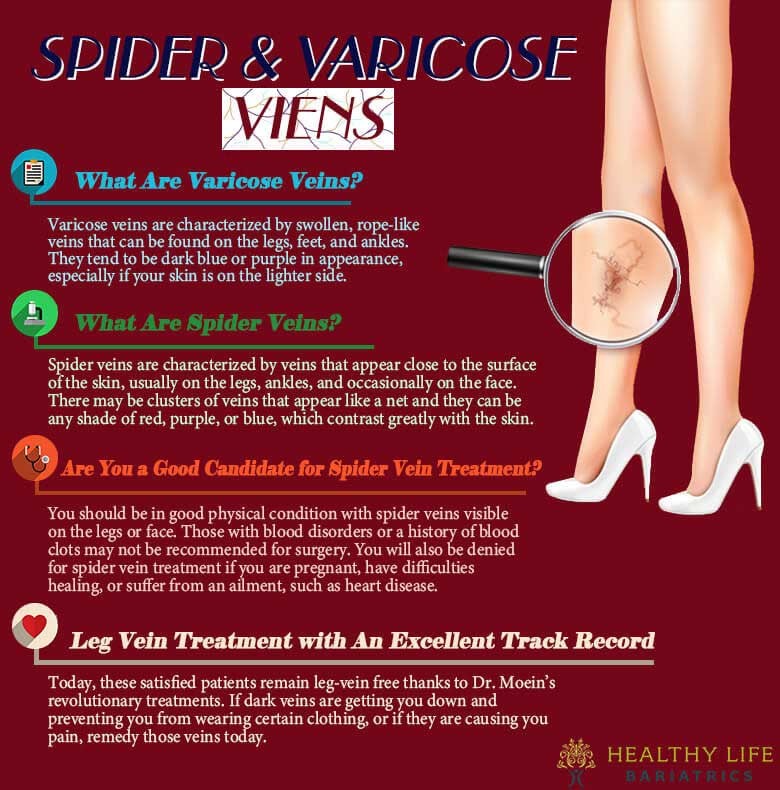 Varicose Vein & Spider Vein Treatment- Los Angeles CA