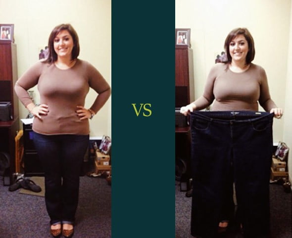 Bariatric Gastric Sleeve Before and After Skin Photos - Los Angeles