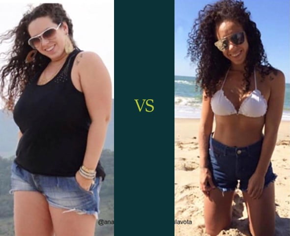 Bariatric Gastric Sleeve Before and After Skin Photos - Los Angeles