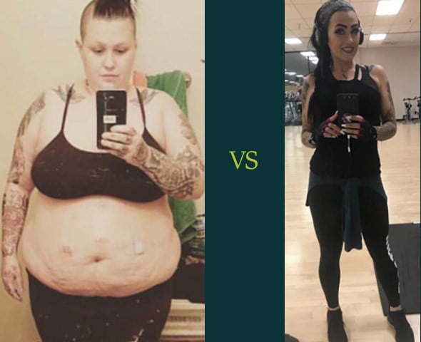 gastric bypass before and after women