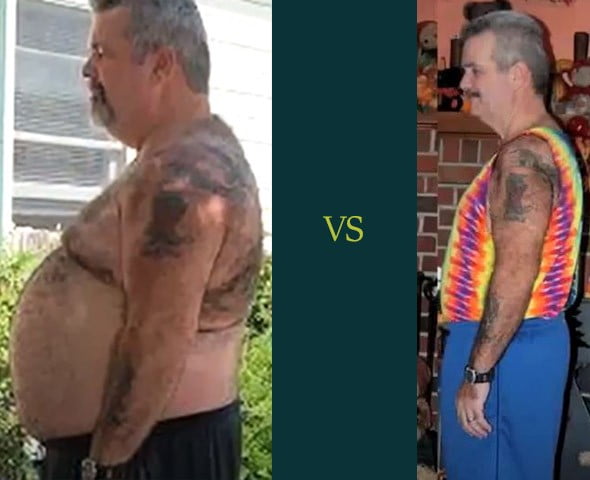 male gastric bypass before and after