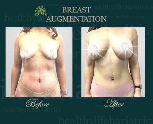 Breast augmentation before and after.