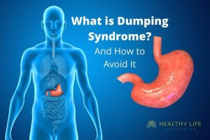 What is dumping syndrome and how to avoid it?.