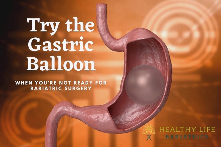 Gastric Balloon Surgery: Alternative to Bariatrics