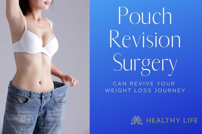 Pouch Revision Surgery Can Revive Weight Loss, Los Angeles,