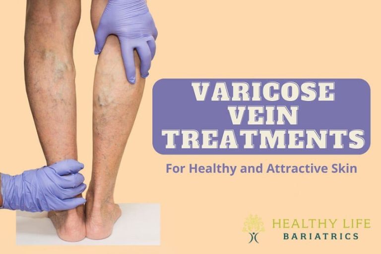 Varicose Veins Treatment Options In Los Angeles Ca