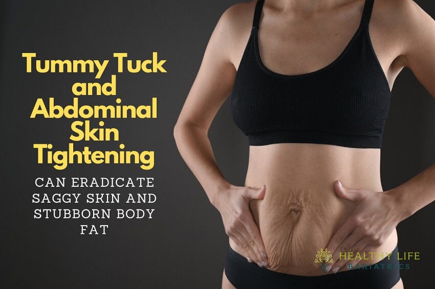 https://healthylifebariatrics.com/wp-content/uploads/2022/09/Tummy-tuck-with-abdominal-tightening-in-Los-Angeles-CA.jpg