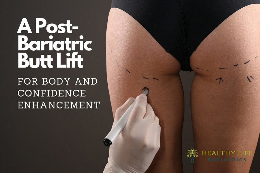 post bariatric butt lift boost confidence in Los Angeles, CA