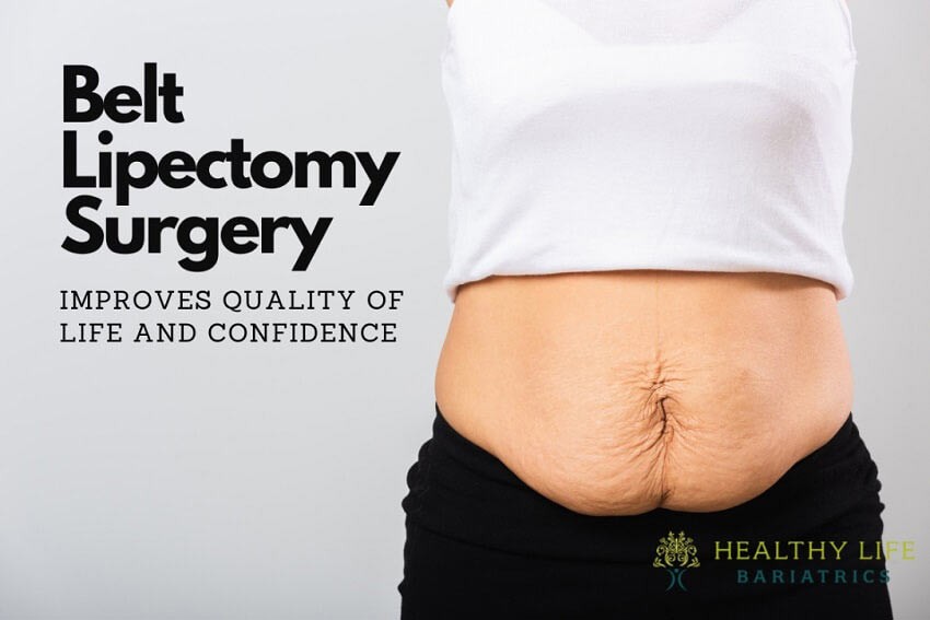 Belt Lipectomy to remove Hanging Skin, Los Angeles