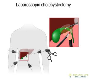 Laparoscopic cholecystectomy.