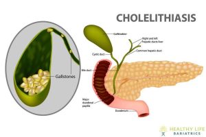 A diagram of cholelithiasis.