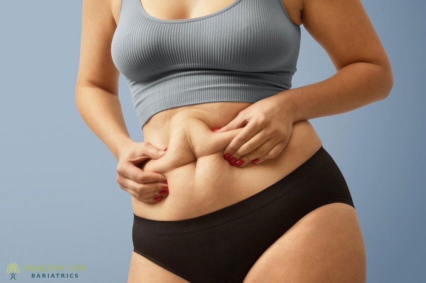 Benefits of Gastric Sleeve Surgery in Pasadena