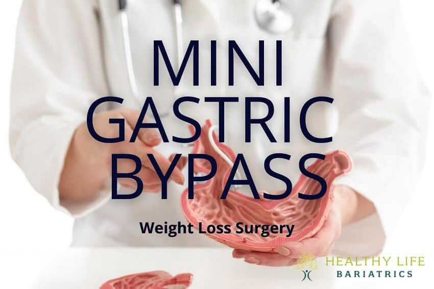 Mini gastric bypass weight loss surgery.