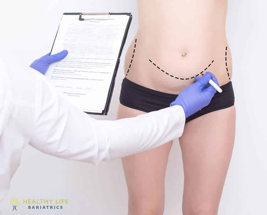 Tummy Tuck Revision Surgery - Moein Surgical Arts