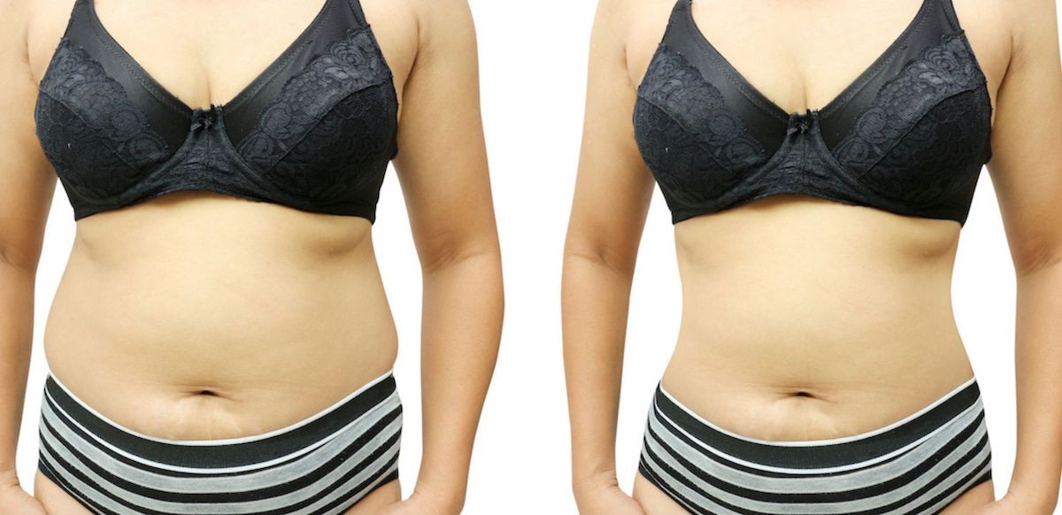 SmartLipo is gaining Popularity