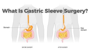 Gastric Sleeve Surgery