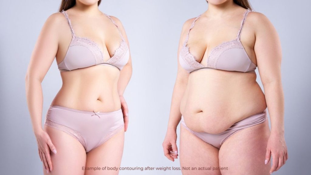 Gastric Sleeve Before and After Skin Results