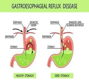 A diagram illustrating the symptoms of gastrosophageal reflux disease after weight loss surgery.