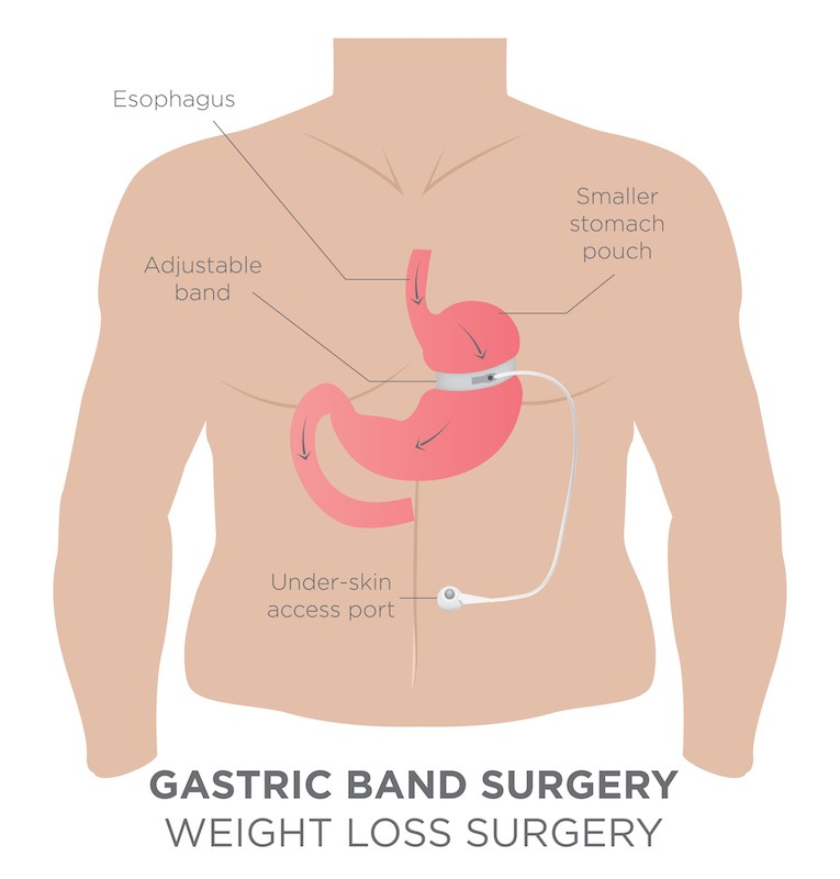 Lap band illustration