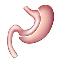 An illustration of a stomach undergoing weight loss surgery on a white background.