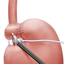 An illustration of a weight loss surgery procedure on a patient's stomach.