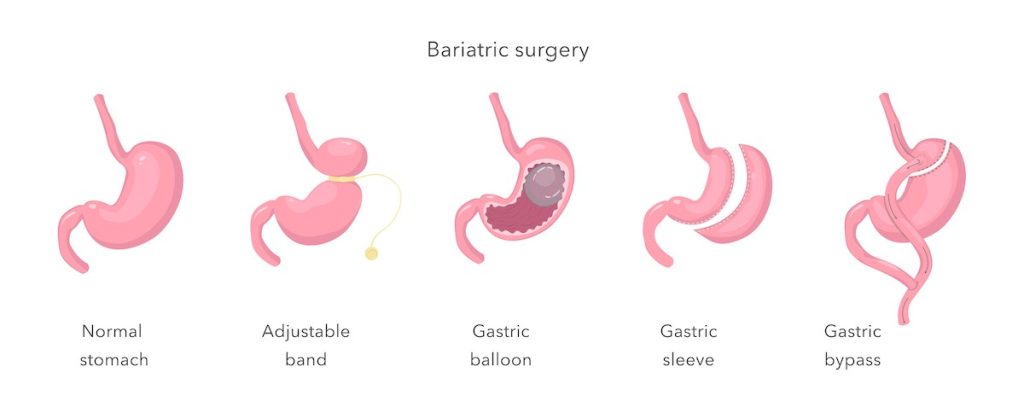 The Role of Bariatric and Metabolic Specialists