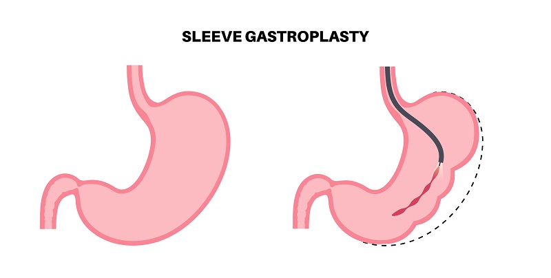 Endoscopic sleeve gastroplasty