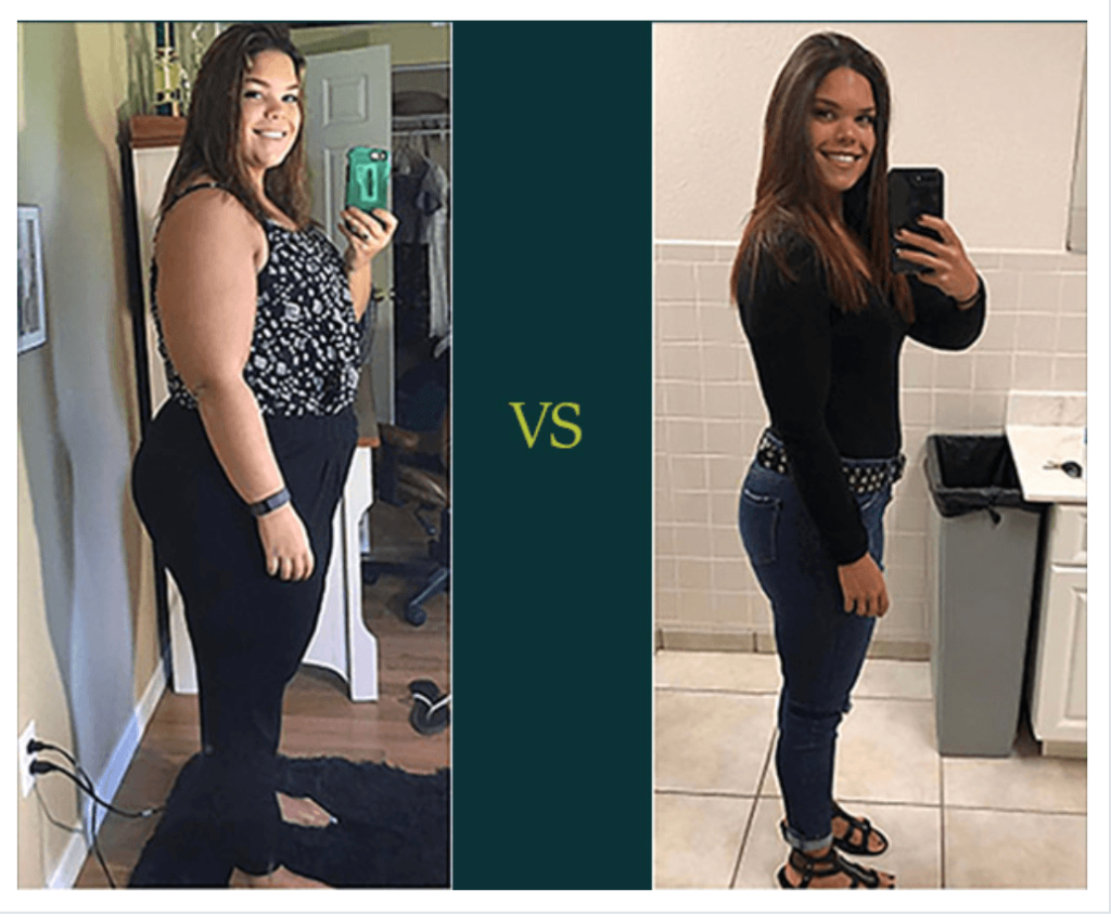 Gastric Sleeve Before and After