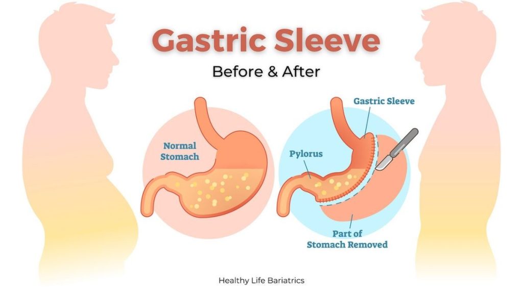 Gastric Sleeve Cost