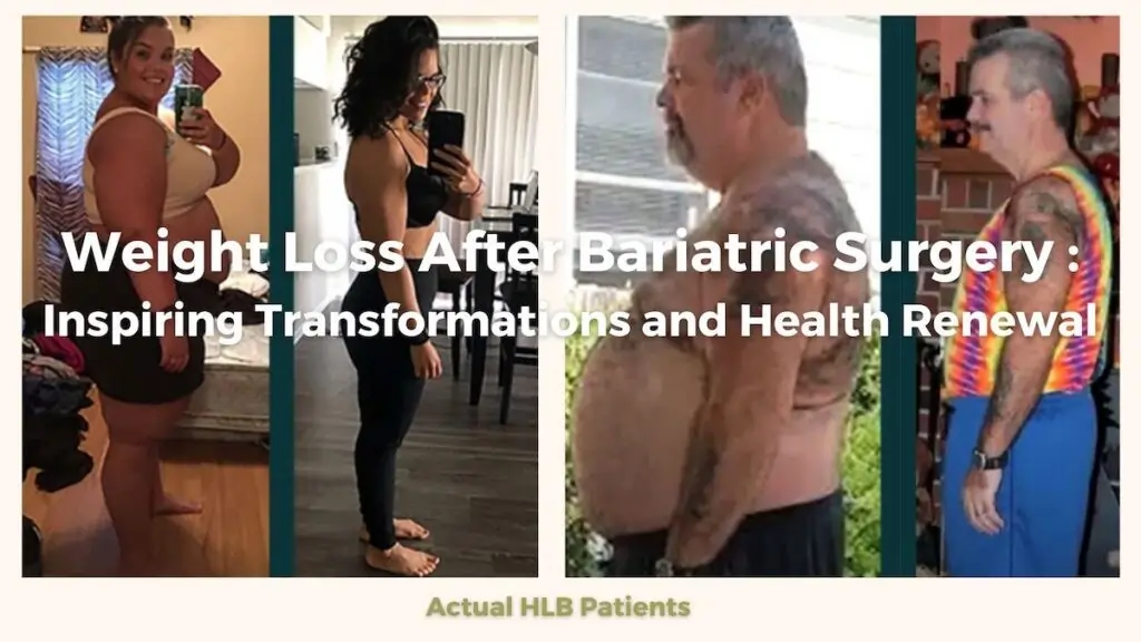 Weight Loss after Bariatric Surgery in LA, CA