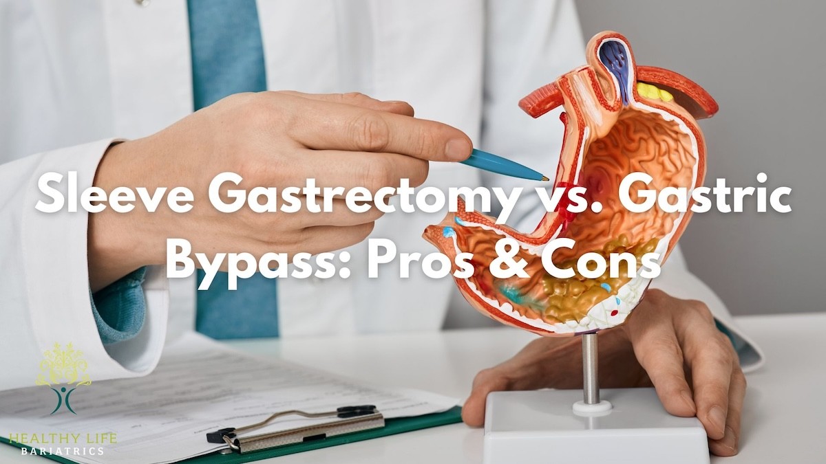 Sleeve Gastrectomy versus Gastric Bypass Los Angeles, CA